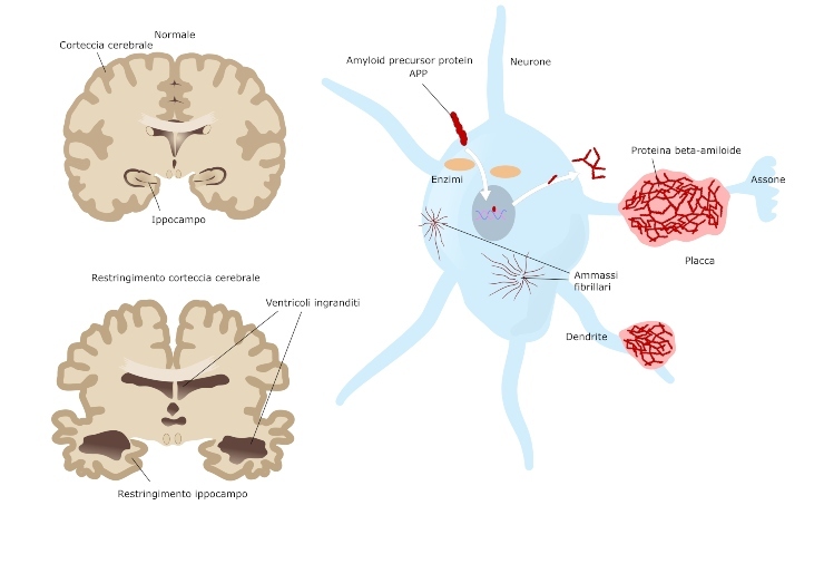 Alzheimer