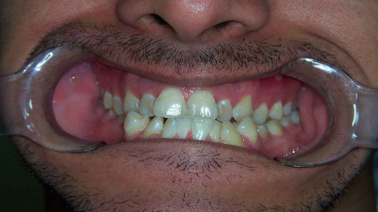 Denti, le alterazioni causate dall'uso delle mascherine anti-Covid-curiosauro.it- 18032022