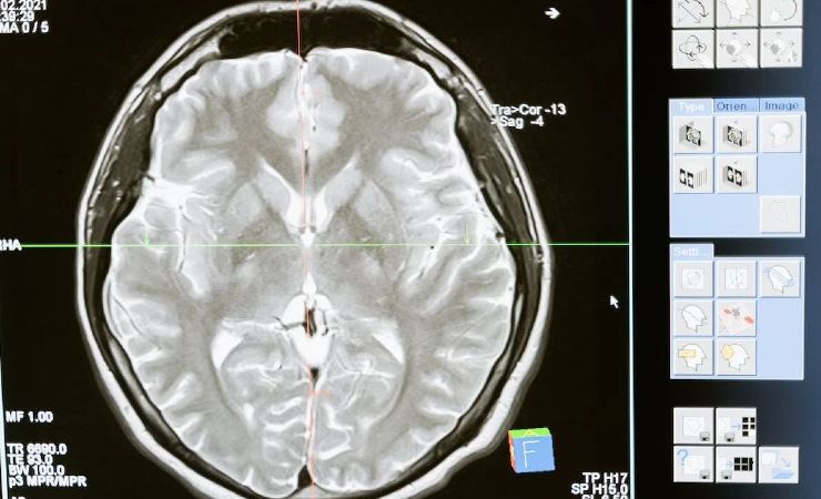 Covid: effetti terribili sugli adolescenti 