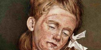 pellagra