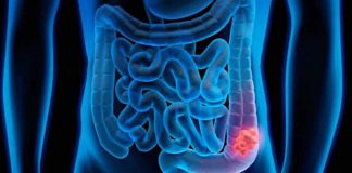 cancro colon