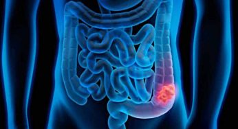 Un nuovo farmaco potrebbe bloccare il cancro del colon | Ecco come