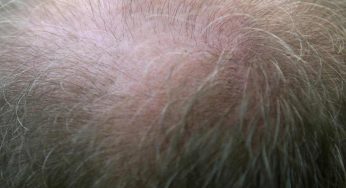 Trapianto di capelli, tutto ciò che c’è da sapere prima di farlo