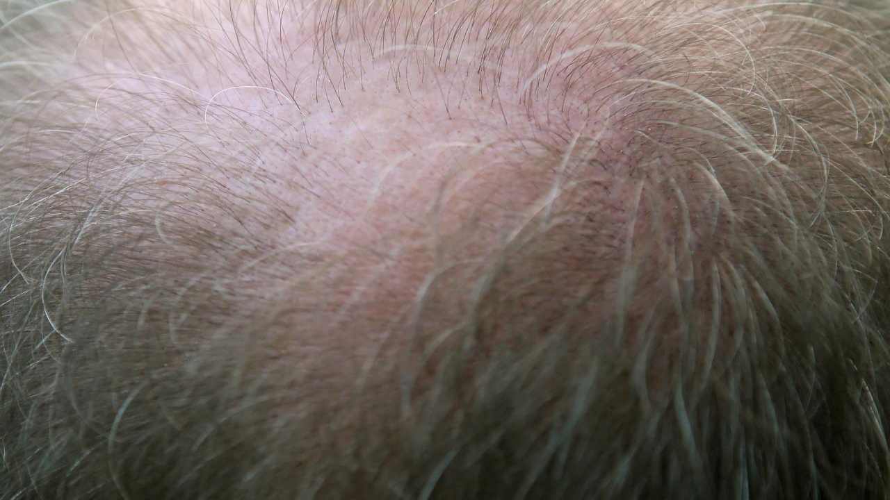 Trapianto di capelli, tutto ciò che c'è da sapere prima di farlo- curiosauro.it- 170522