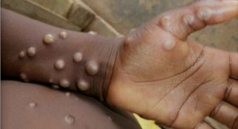 Vaiolo delle scimmie | Tutto ciò che c’è da sapere sulla nuova infezione