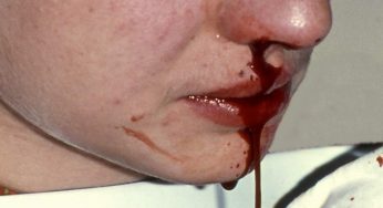 Sangue dal naso | Quando è il caso di preoccuparsi?