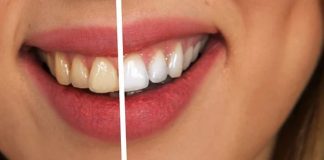 Come sbiancare i denti