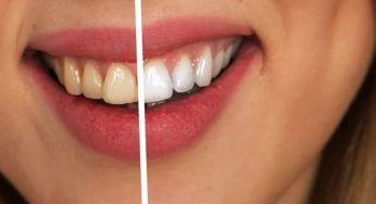 Denti bianchi: con questi 4 metodi otterrai un risultato stupendo e definitivo