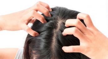 Addio forfora e ‘nevischio sulle spalle’: ti consiglio 5 rimedi naturali dall’effetto miracoloso