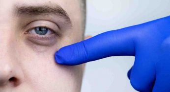 Le occhiaie? Non sono causate dal sonno | Incredibile ma vero: ecco a cosa sono dovute