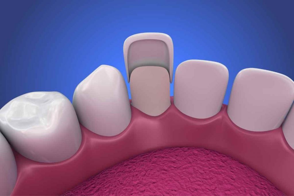 quanto costa una faccetta dentale